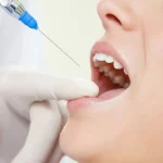 Botox: A New Dimension in Alleviating Dental Tension